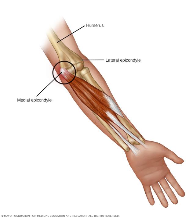 Bone Golfe: What Is It and How to Prevent It?